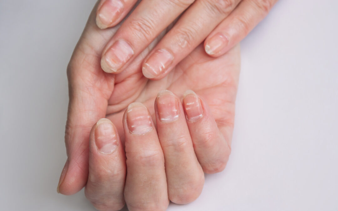 nail damage